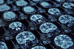 Conselho Federal de Medicina altera regras para realizao de neuropsicocirurgia