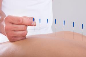 STJ ratifica tese do CFM e probe prtica de acupuntura por educadores fsicos